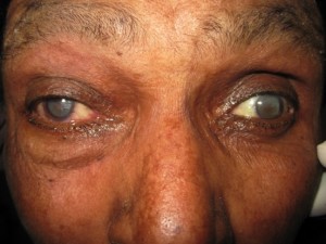 Blind sees again